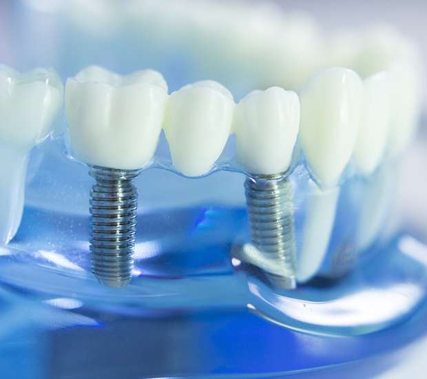 Fairfield Dental Implants
